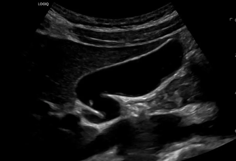 Ultrasound image highlighting a healthy gallbladder