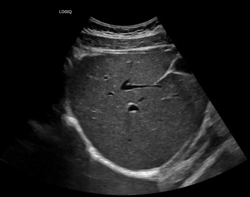 A liver ultrasound image revealing the intricate textures and structures of the liver