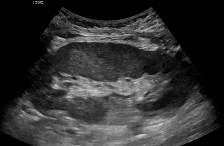 Close-up of a screen displaying a renal transplant ultrasound